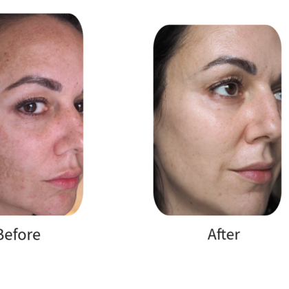 Xtralite Cream: Azelaic Acid & Tretinoin.