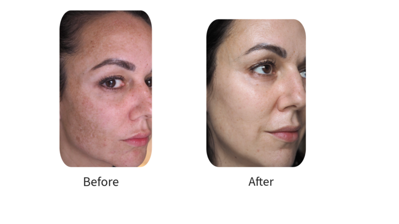 Xtralite Cream: Azelaic Acid & Tretinoin.
