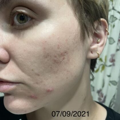 Tretinoin gel tube.