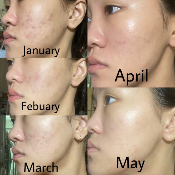 Acnatac Gel tube. Acne treatment.