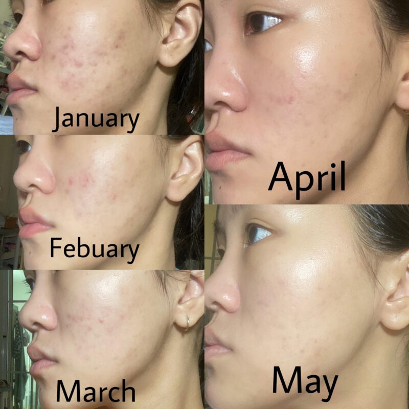 Acnatac Gel tube. Acne treatment.