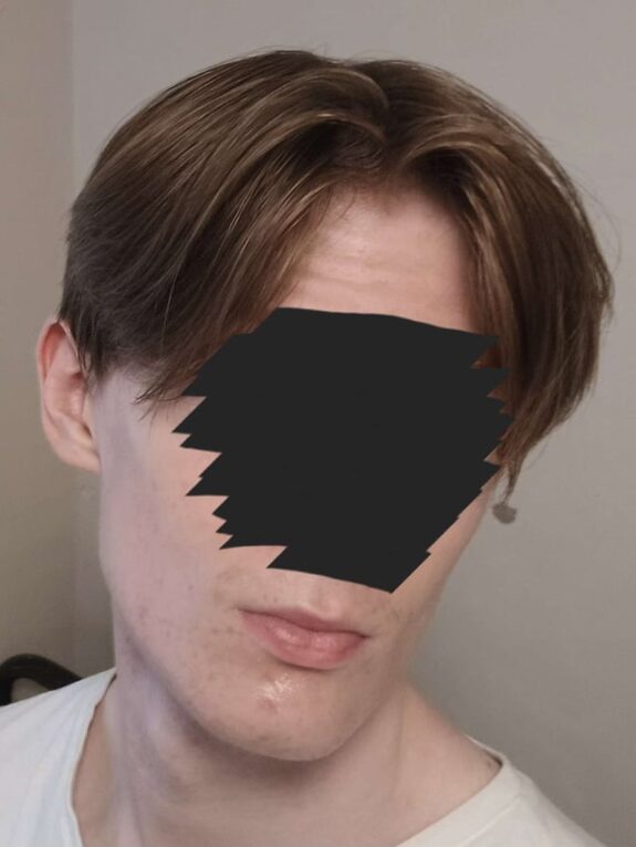 Acnatac Clindamycin and Tretinoin topical acne treatment.
