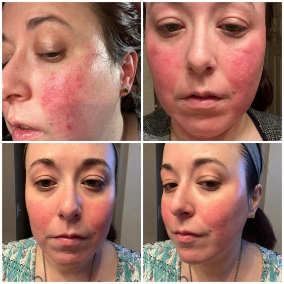 Metronidazole and Tretinoin Gel.