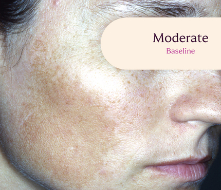 Tretinoin Cream 0.05% for Melasma treatment.