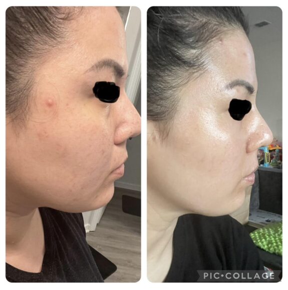 Tazorac 0.05% Gel acne treatment
