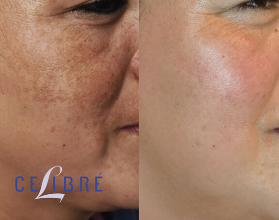 12 Hydroquinone Cream: Before & After skin improvement results.