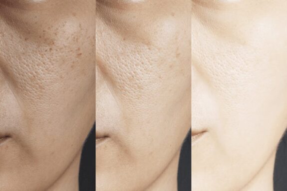 Retinol and hydroquinone skincare set.