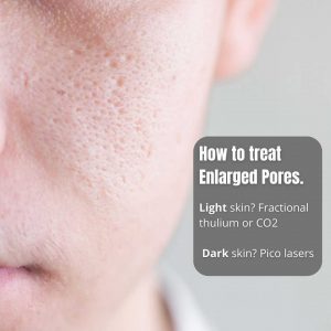 Tretinoin 0.025% cream for open pores.
