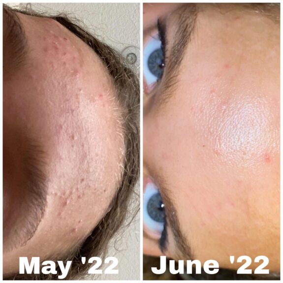 Tretinoin & CeraVe Moisturizing Cream.