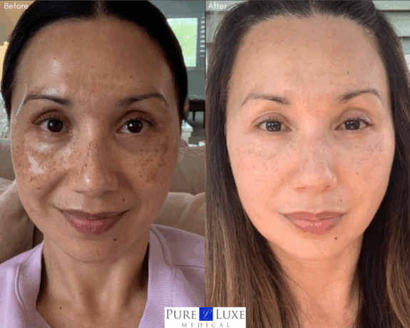 Zo Skin Health Pigment Control: Before & After results.