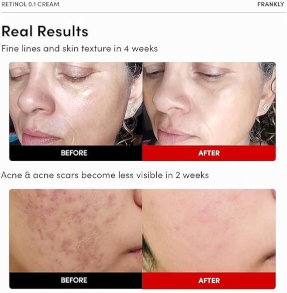 Tretinoin Cream 2% - Skincare product