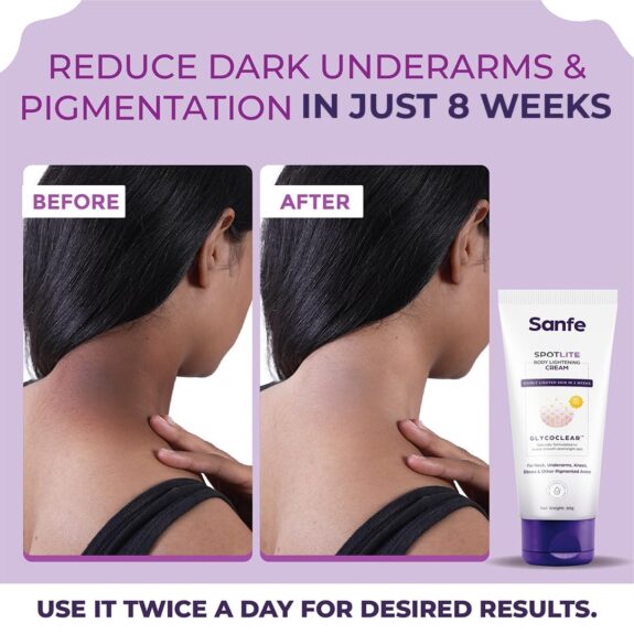 Tretinoin cream for dark neck treatment.