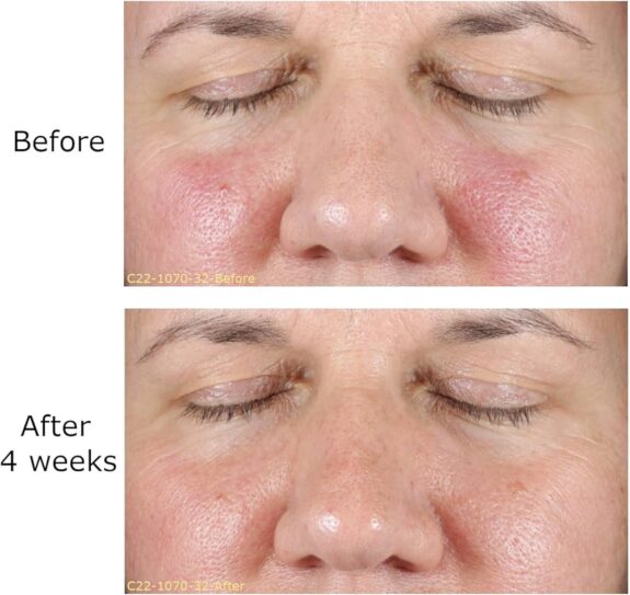 Tretinoin 0.025% cream before & after results.