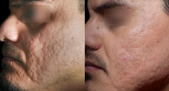 Tretinoin cream for ice pick scar treatment.