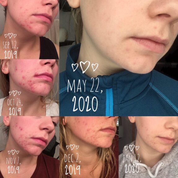 Stieva-A 0.05% tretinoin before & after treatment results.