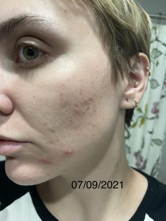 Tretinoin Cream 0.05% tube