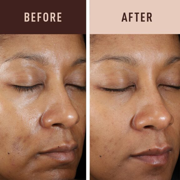 4 Hydroquinone Cream: Before & After skin improvement results.