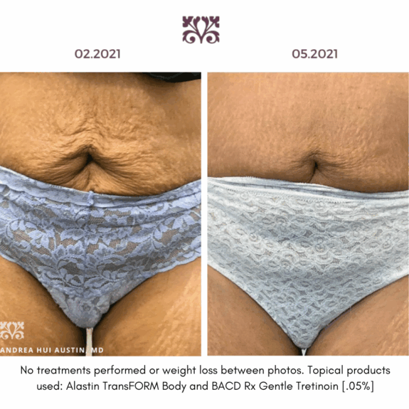 Tretinoin 0.05% before & after results. See visible skin improvement.