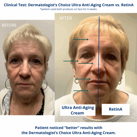 Wrinkle cream with tretinoin.