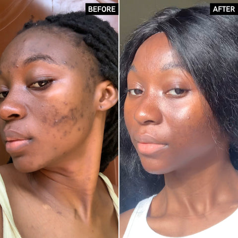 Retin-A before & after: showing improved skin texture and tone.