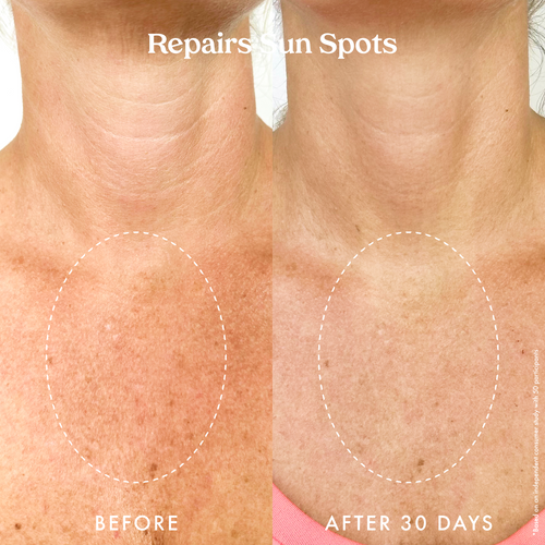 Retin-A chest treatment: before & after photos showing improved skin texture.