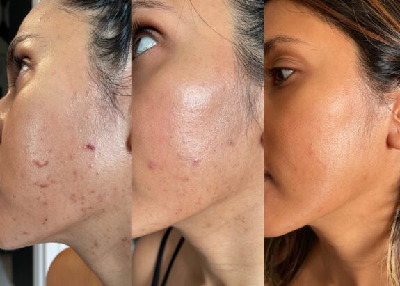 Retacnyl before & after: acne treatment results.