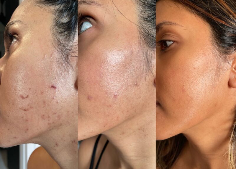 Retacnyl before & after: acne treatment results.