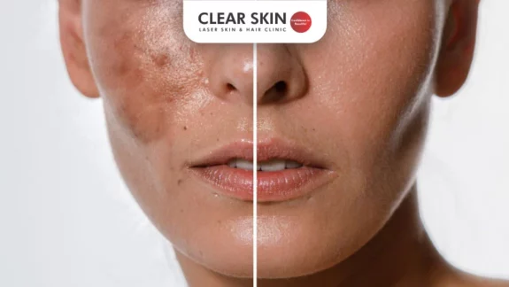 Tretinoin Cream 0.025% for Melasma treatment