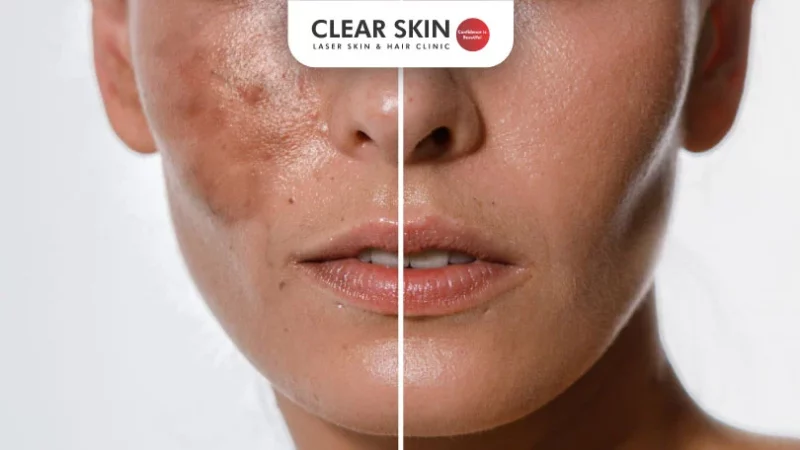 Tretinoin Cream 0.025% for Melasma treatment