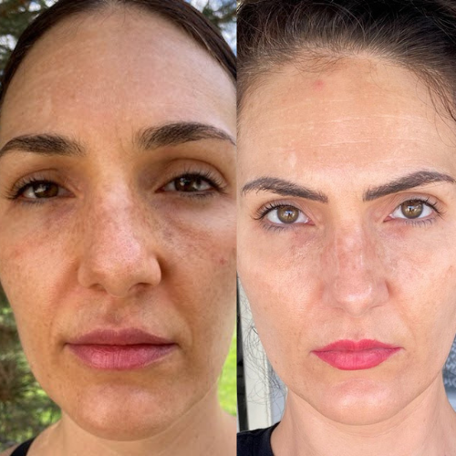 Tretinoin before & after melasma treatment results.