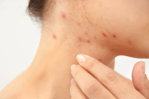 Tretinoin cream for folliculitis treatment.