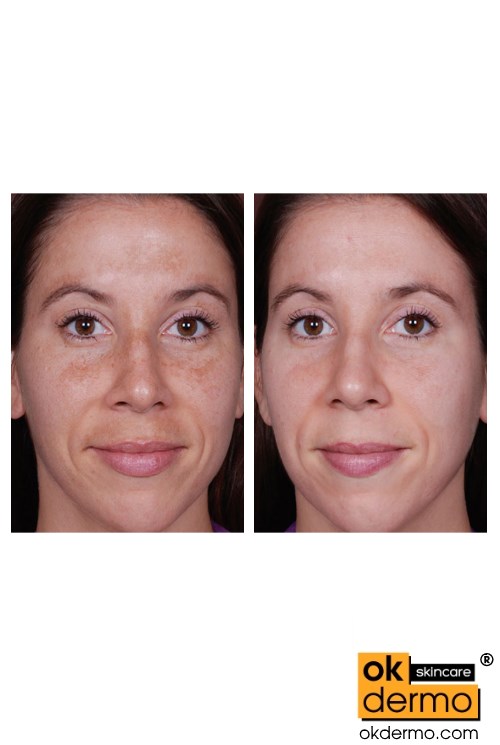 Vitaquin Before & After: showcasing product effectiveness.