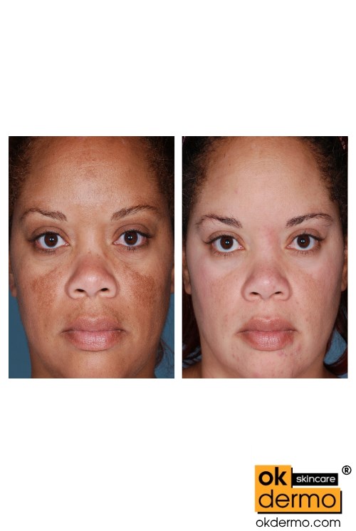 Skin Brightening Hydroquinone cream.