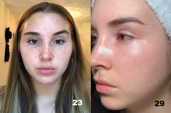 Tretinoin cream for reducing freckles.