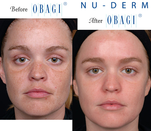 Obagi Tretinoin before & after photos showing skin improvement.