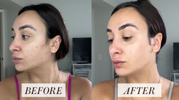 Topical tretinoin before & after: showing improved skin texture.