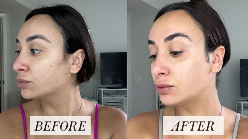 Tretinoin cream before & after: showing improved skin texture.