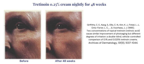 Tretinoin 0.025% before & after results.