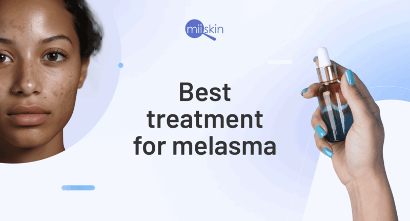 Tretinoin cream for melasma treatment.