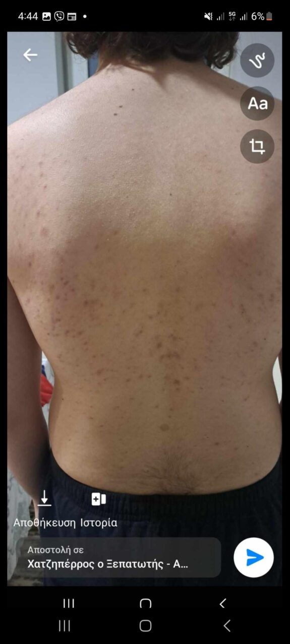 Tretinoin cream for acne treatment.