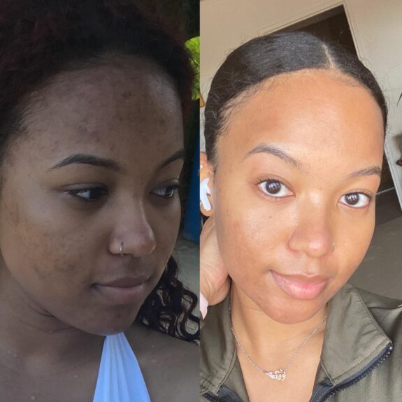 Tretinoin cream for hyperpigmentation treatment.