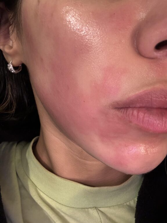 Tretinoin cream burn: irritated skin showing redness and peeling.