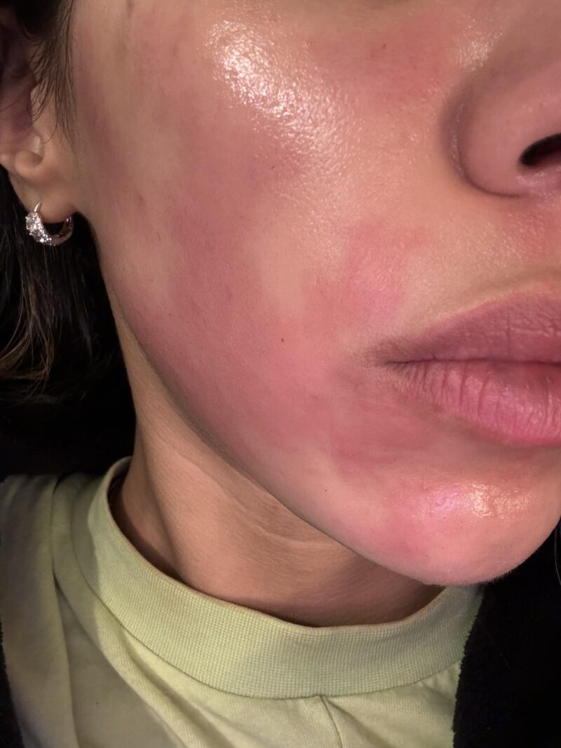 Tretinoin cream burn: irritated skin showing redness and peeling.