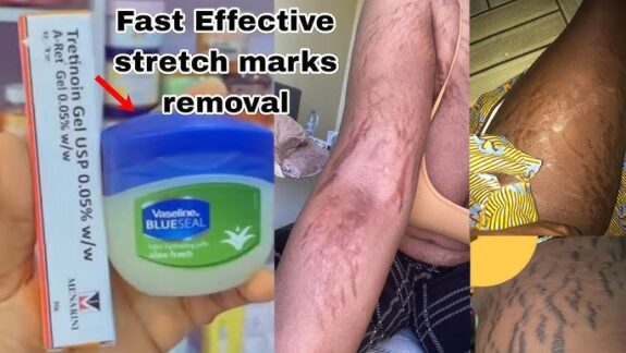 Stretch Mark Cream with Tretinoin.