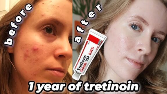 Tretinoin 0.05% cream before & after results.