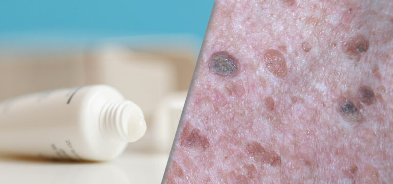 Tazarotene Cream for Seborrheic Keratosis