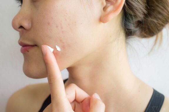 Tretinoin cream for skin lightening.