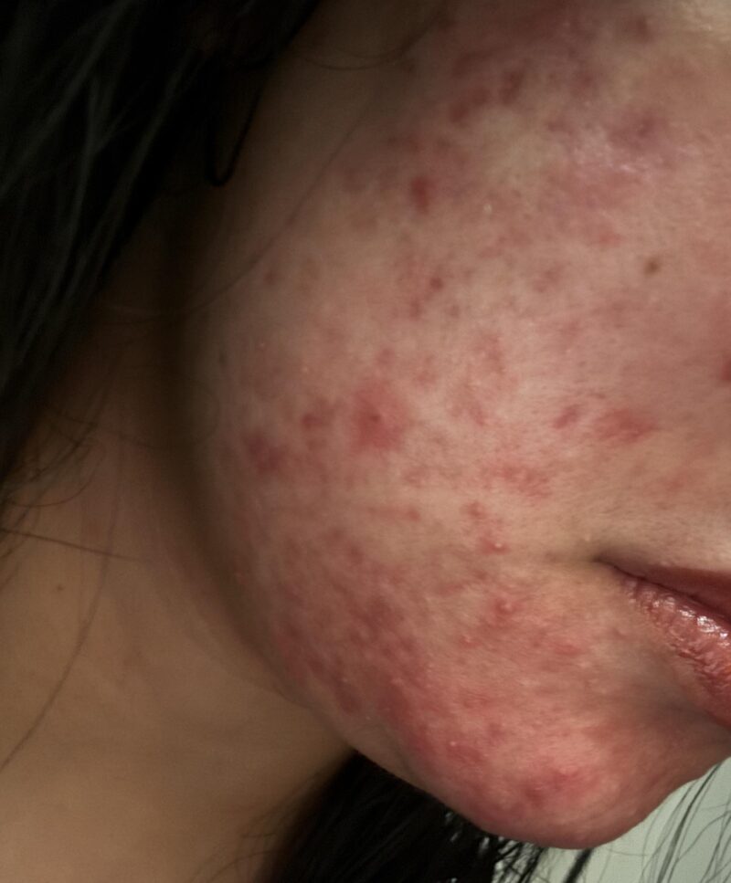 Tretinoin cream for rosacea treatment.