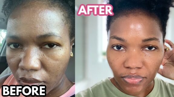 Tretinoin cream, dark skin tone.