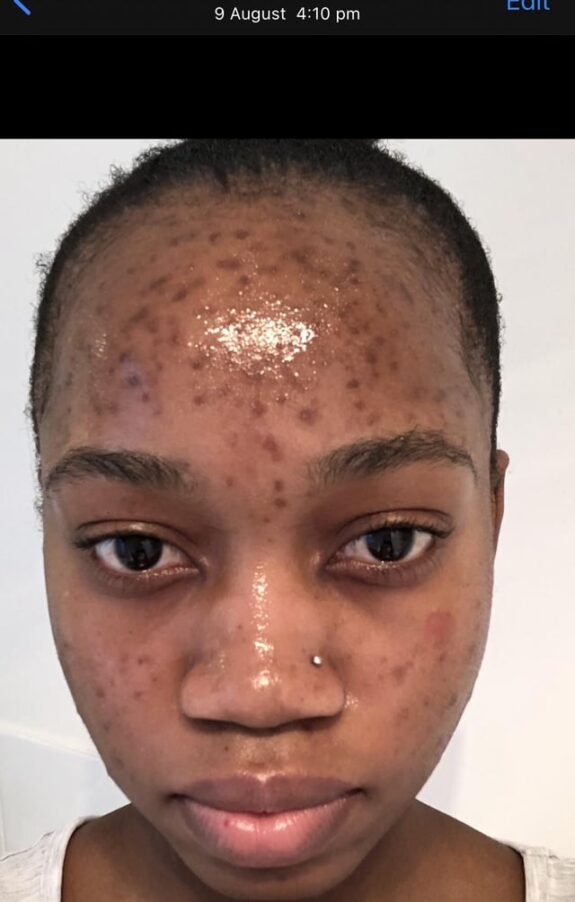 Tretinoin and hydroquinone cream. Skincare product.